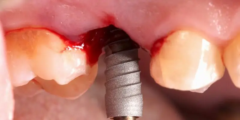 Level 1, Basic Implantology: the technique